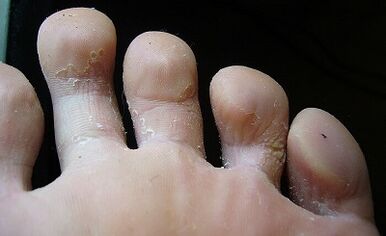 Che aspetto ha il fungo sulle gambe e come trattarlo