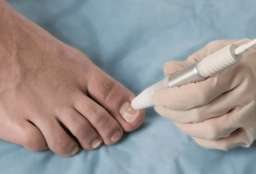 irradiazione uf