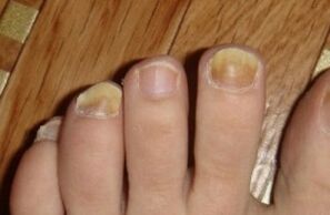 ingiallimento dell'unghia a causa di funghi